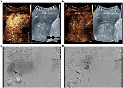 Fatal acute-on-chronic liver failure following camrelizumab for hepatocellular carcinoma with HBsAg seroclearance: a case report and literature review
